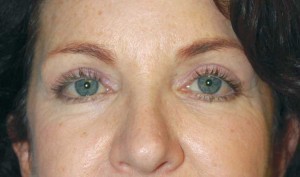 beauty-part-Upper-Eyelid-after