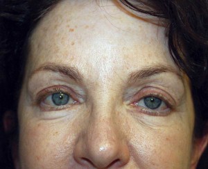 beauty-part-Upper-Eyelid-before